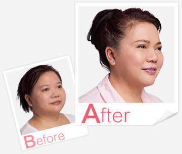 產(chǎn)后康復(fù)